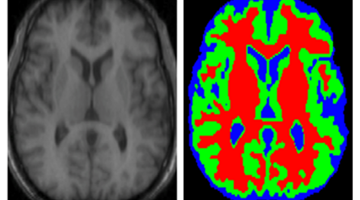 Segmentation d'image en imagerie médicale