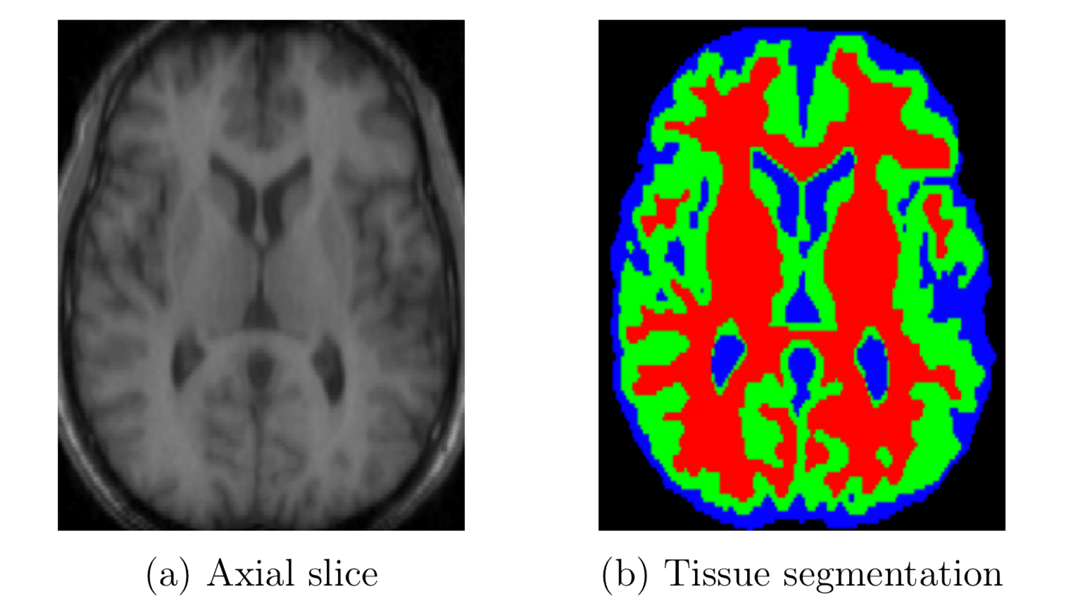 Figure 1: A segmentation of an axial brain slice. Red, green and blue correspond to white matter, gray matter and cerebrospinal fluid respectively. 