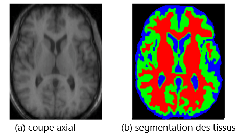 Figure 1 : Segmentation d'une coupe axiale du cerveau. Le rouge, le vert et le bleu correspondent respectivement à la matière blanche, à la matière grise et au liquide céphalorachidien. (Source de l'image : A review of medical image segmentation: methods